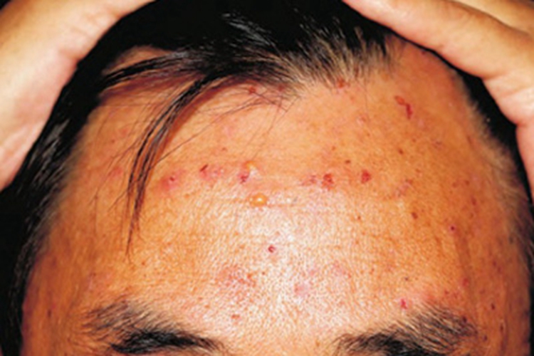 疱疹样皮炎前额症状图 疱疹样皮炎前额症状图