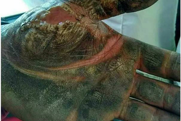 电烧伤手部皮肤发黑图