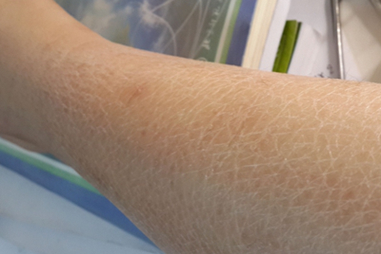 慢性维生素A过多症小腿裂纹图