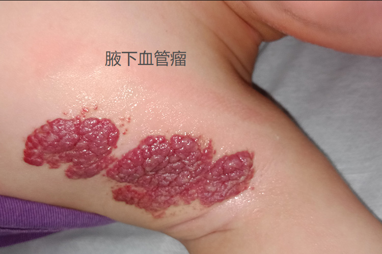 腋下大片血管瘤图