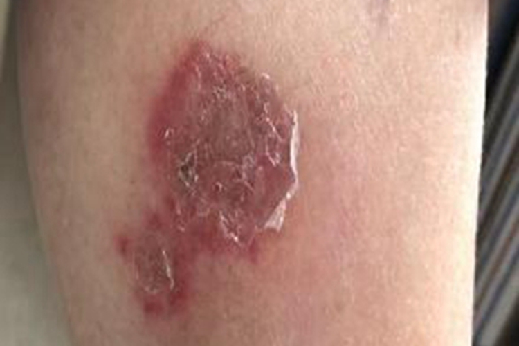 急性发热性嗜中性皮病小腿脱皮图 急性发热性嗜中性皮病小腿脱皮图