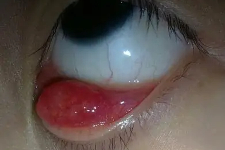 内睑腺炎症状图 内睑腺炎症状图