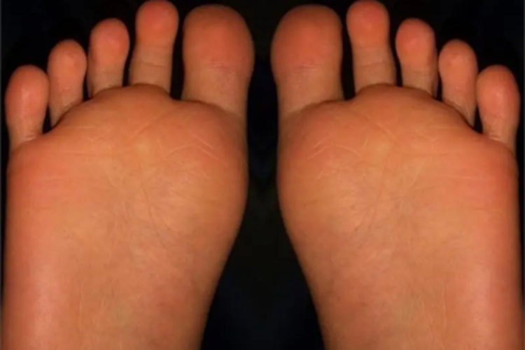 弥漫性掌跖角皮症脚底皮肤增厚图