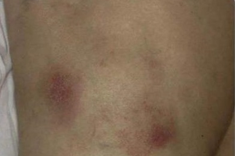 人工性脂膜炎红斑图