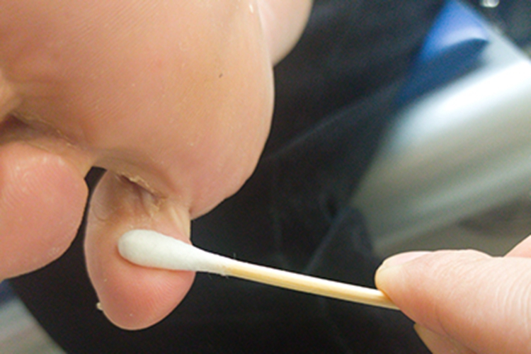 糜烂型足癣脚趾脱屑图