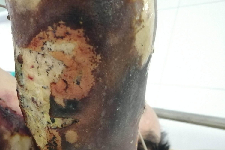 烧伤焦痂图 烧伤焦痂图