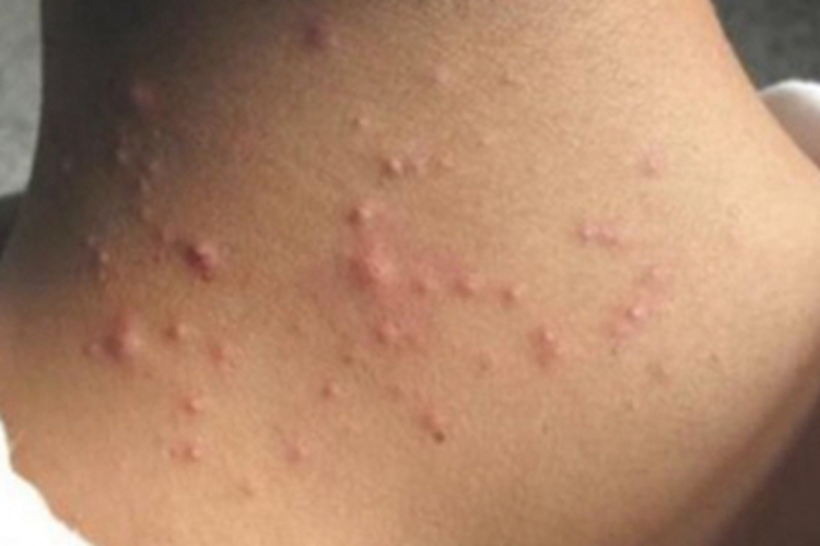 马拉色菌毛囊炎颈部粉刺丘疹图 马拉色菌毛囊炎颈部粉刺丘疹图