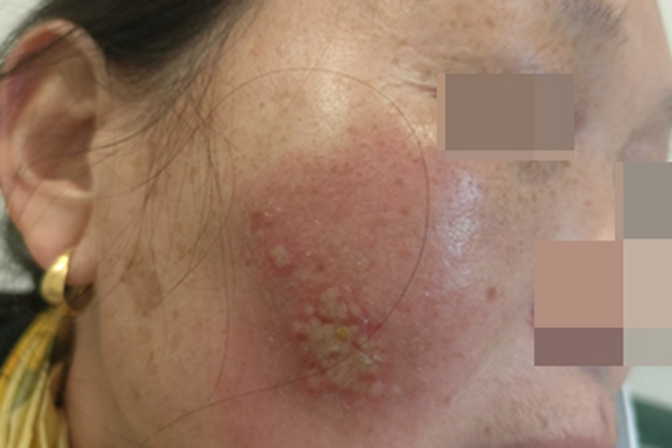 疱疹样湿疹面部脓疱图