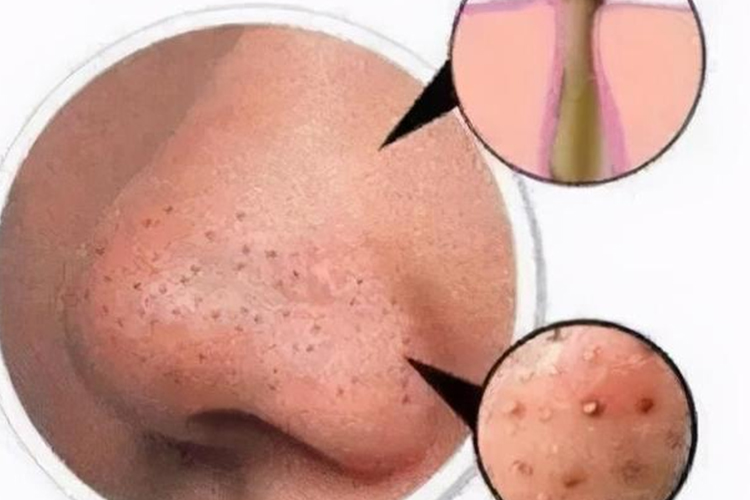 黑头粉刺图 黑头粉刺图