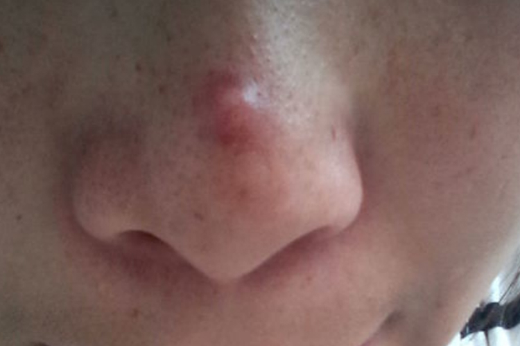 鼻子上长黄豆大小的纤维瘤图 鼻子上长黄豆大小的纤维瘤图