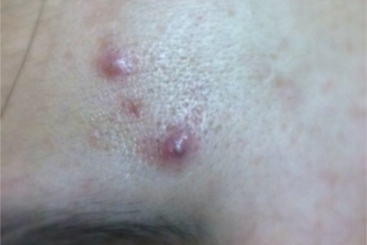 毛囊炎前额有炎性丘疹图