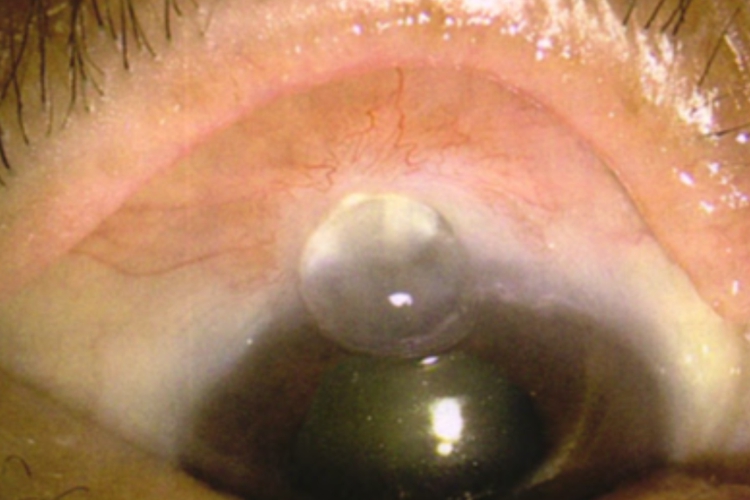 青光眼滤过泡正常图
