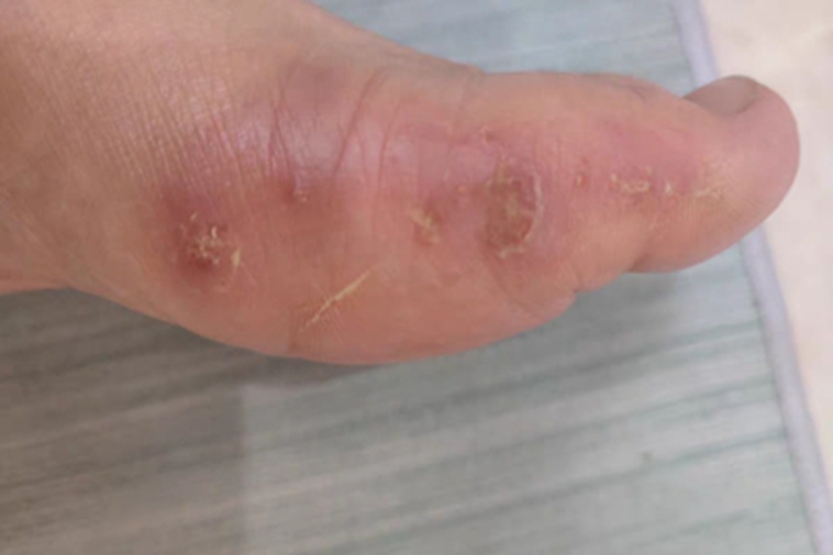 水疱型足癣脚上有红斑结痂图