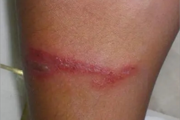 隐翅虫皮炎小腿红斑图