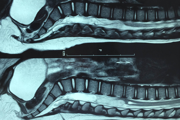 先天性皮毛窦影像图