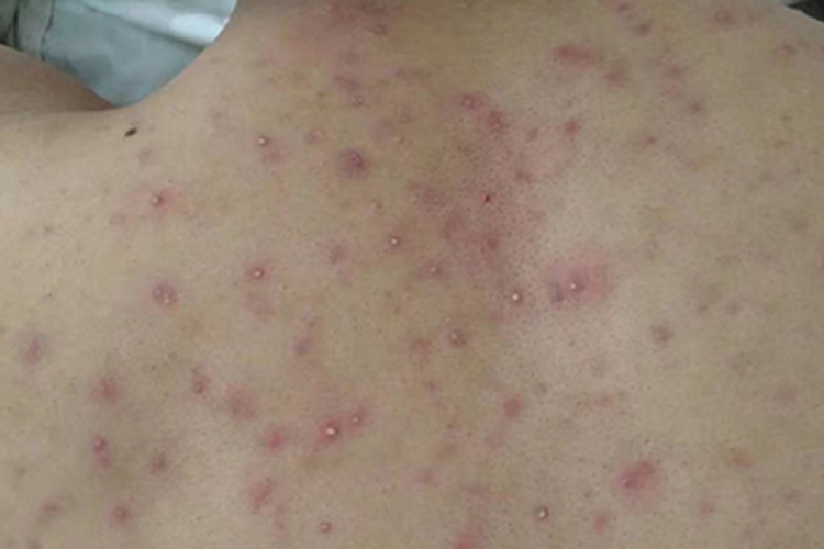 毛囊炎背部很多红色疙瘩图