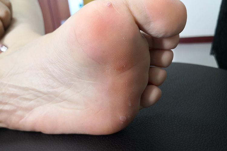 跖疣初期小丘疹图