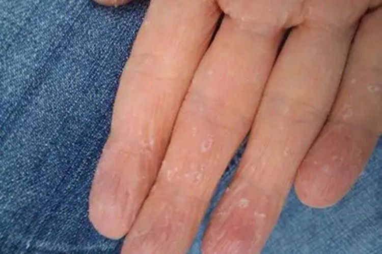 浸渍擦烂性皮炎手部脱皮图 浸渍擦烂性皮炎手部脱皮图
