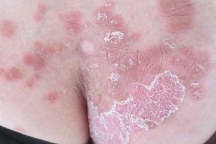 寻常型银屑病屁股有红斑脱皮图