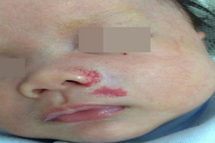 蔓状血管瘤面部有一片红斑图