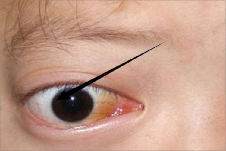 眼眶海绵状血管瘤眼部凸出图