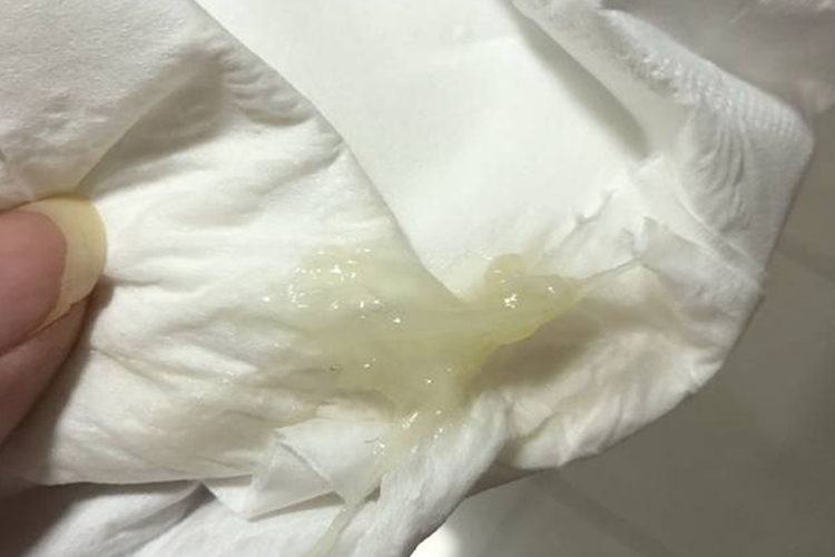 孕中期宫颈黏液栓图 孕中期宫颈黏液栓图