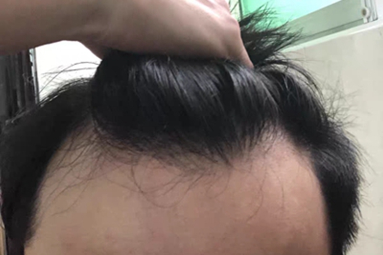 雄激素性脱发头顶发际线后退图