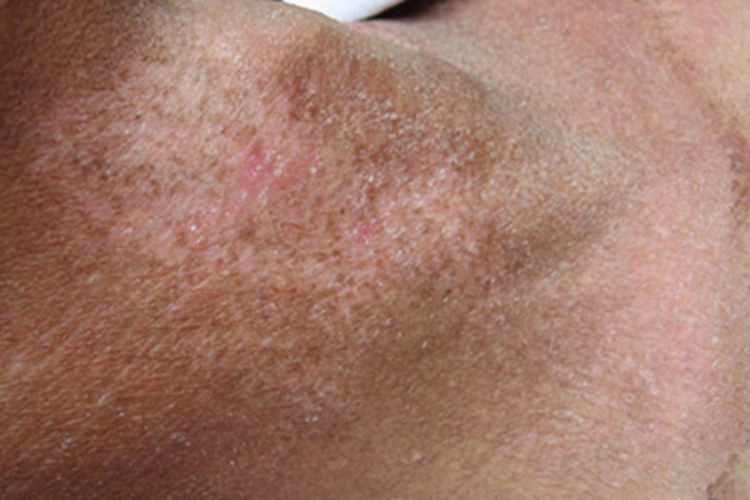 放射性皮炎脱屑图 放射性皮炎脱屑图