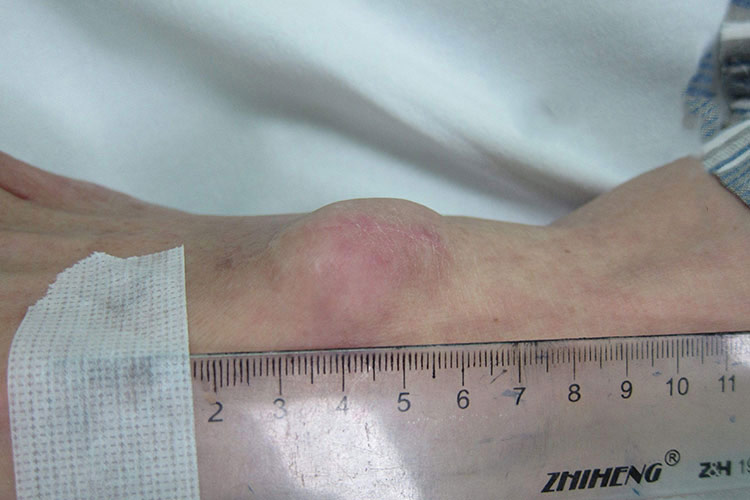 足背隆起综合征图 足背隆起综合征图