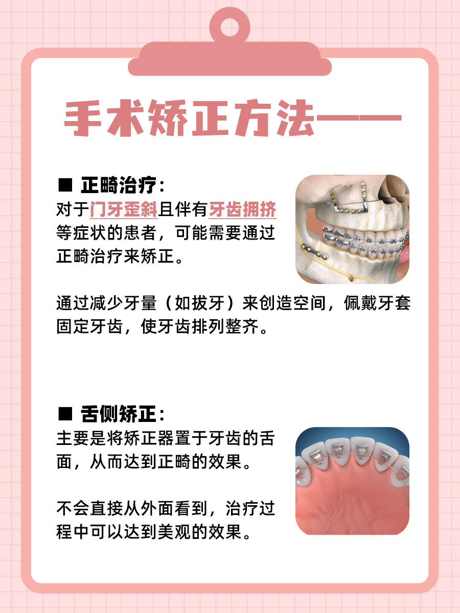 门牙歪斜影响美观，记得及时去矫正，别大意！