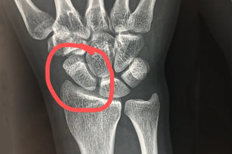 手腕骨裂图