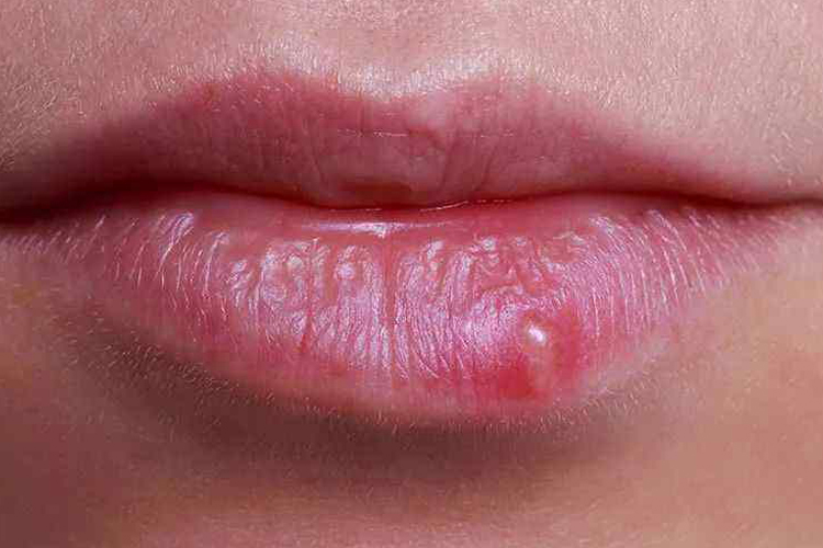 唇炎嘴唇长水疱图