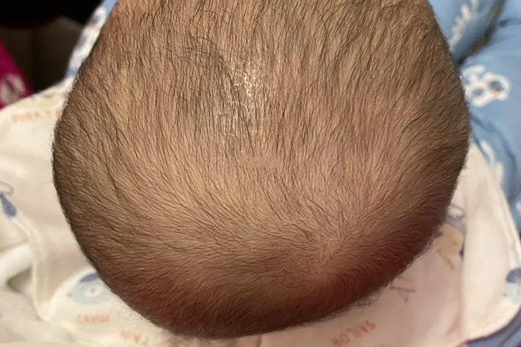 斜头畸形图 斜头畸形图