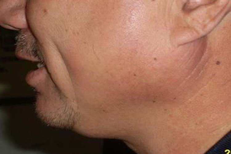 流行性腮腺炎肿大腮图