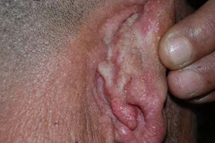 黏液水肿性苔藓耳部肿块图 黏液水肿性苔藓耳部肿块图