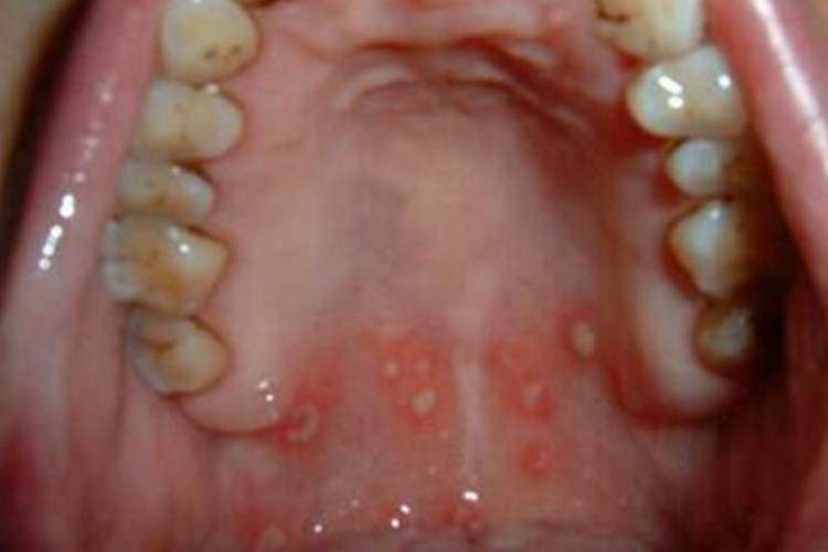 二期口腔梅毒口腔溃疡图