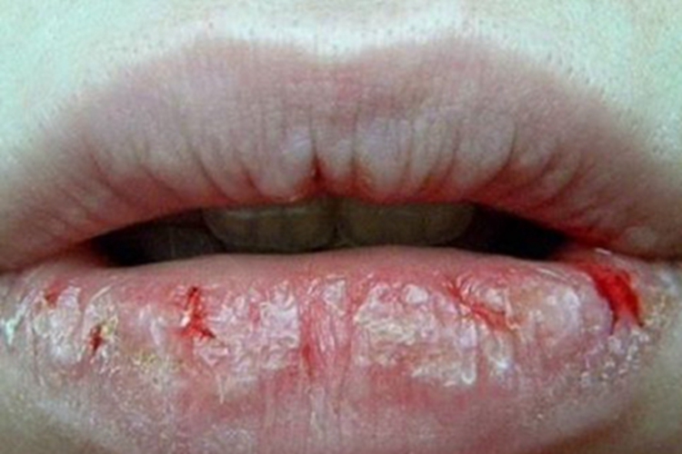 接触性唇炎血痂图