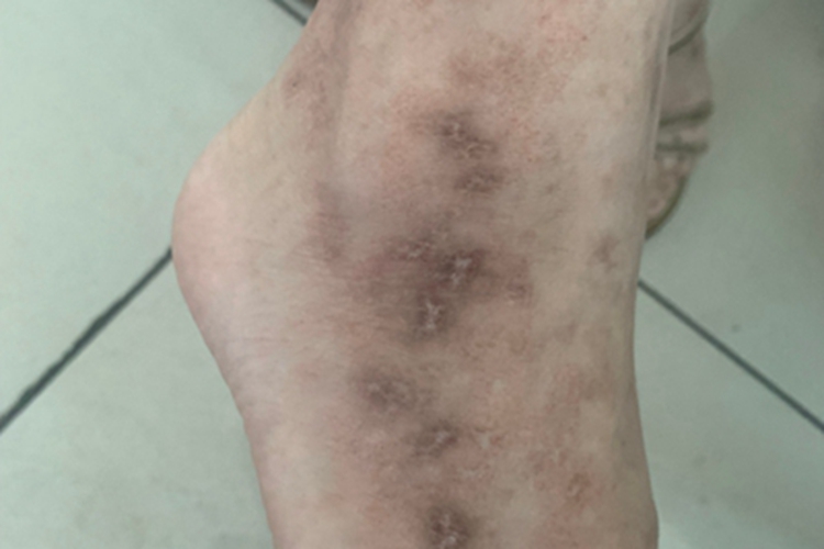 变应性皮肤血管炎脚踝有鳞屑图