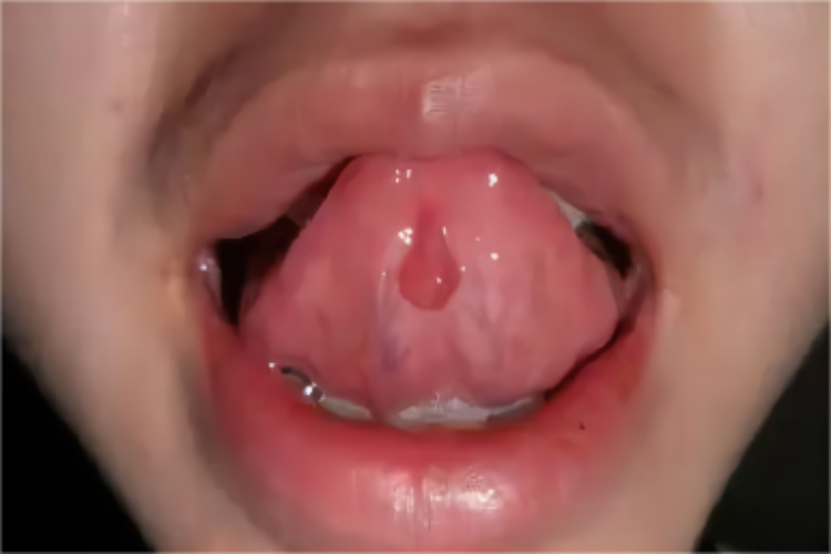 舌头黏液囊肿图