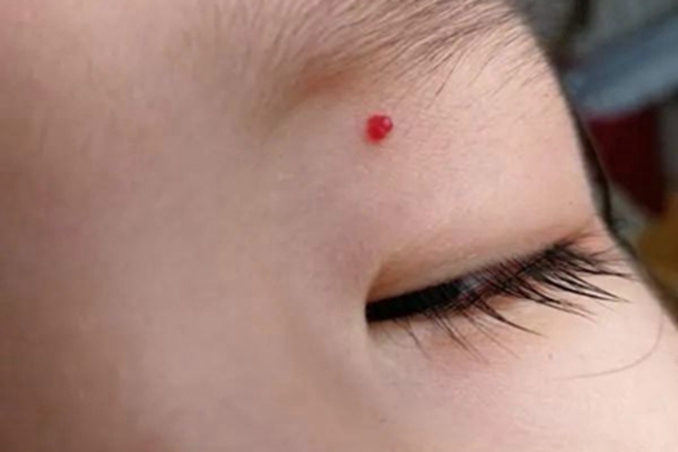 化脓性肉芽肿眼周小红疙瘩图