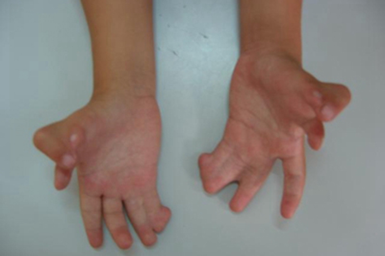 并指畸形手部长在一起图