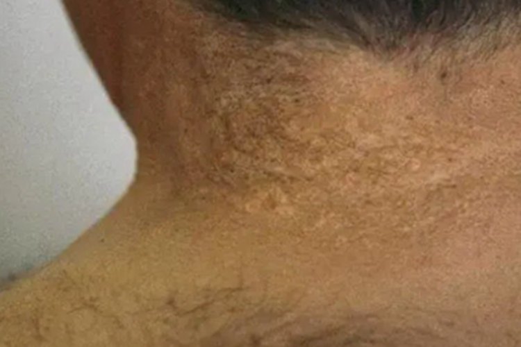 小儿弹性假黄瘤颈部症状图 小儿弹性假黄瘤颈部症状图