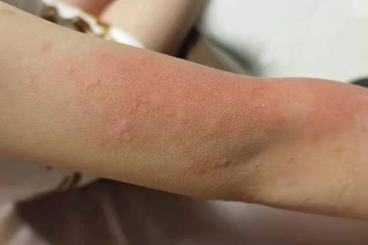 急性发作的风团图