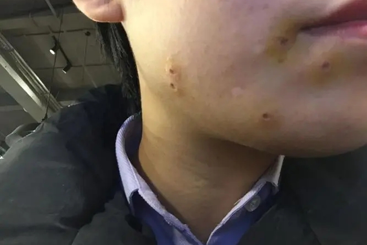 男士冷冻点痣图