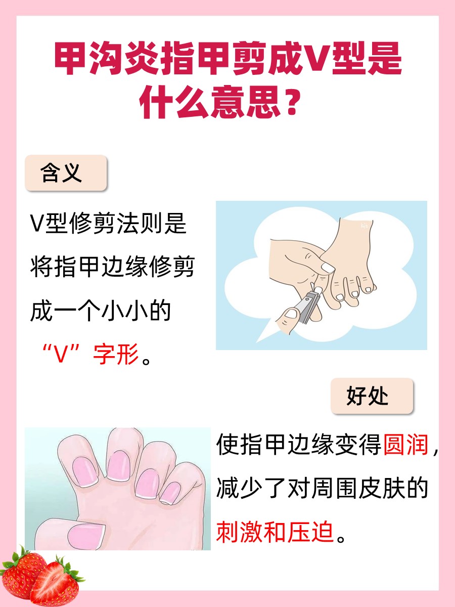 告别甲沟炎烦恼！医生建议V型剪法让指甲重生