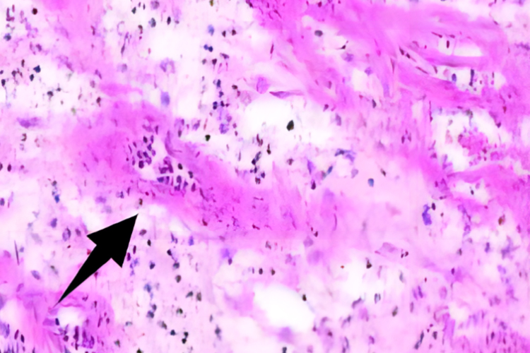 镜下肉芽组织新生的毛细血管图 镜下肉芽组织新生的毛细血管图