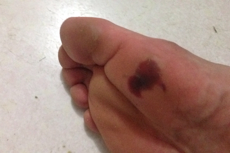 脚底有红色块状淤血图