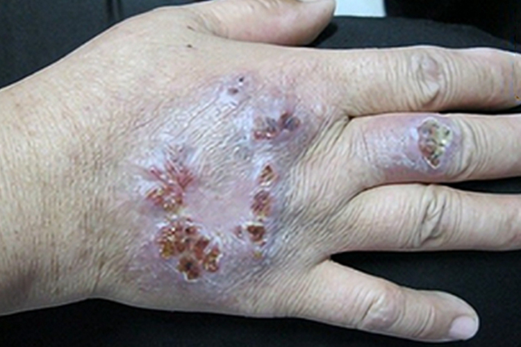 皮肤非典型分枝杆菌病手背溃疡图