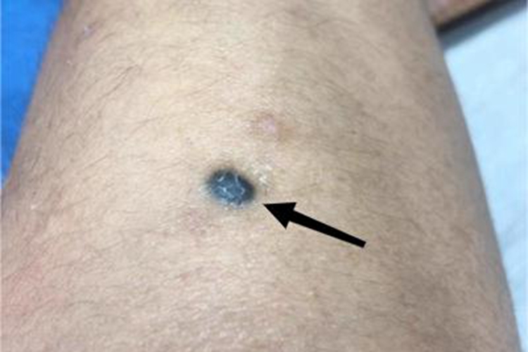 皮内痣小腿黑痣图