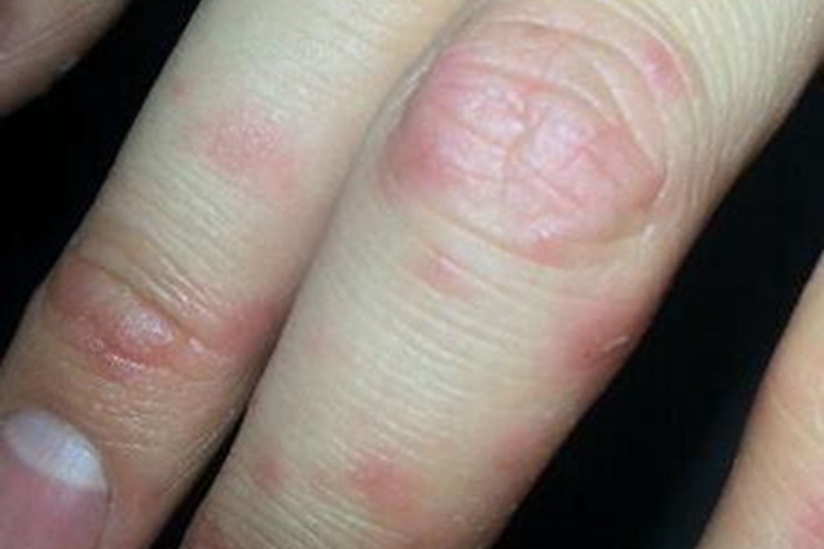 寒冷性多形红斑丘疹图